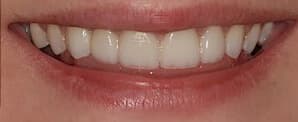 after porcelain veneers treatment