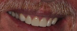 upper teeth after porcelain veneers treatment