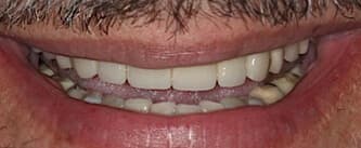 upper teeth after EMAX crowns procedure