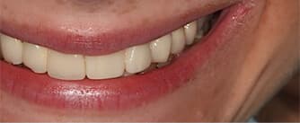 after dental implants and EMAX crown procedures