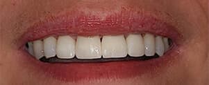 after cosmetic dental treatments