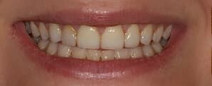 before porcelain veneers treatment