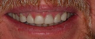 upper teeth before porcelain veneers treatment
