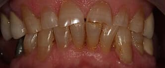 upper teeth before EMAX crowns procedure