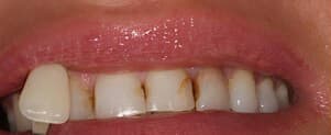 before cosmetic dental treatments